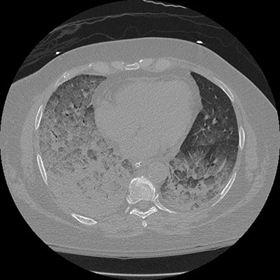 Chest CAT scan of a patient with active plastic bronchitis